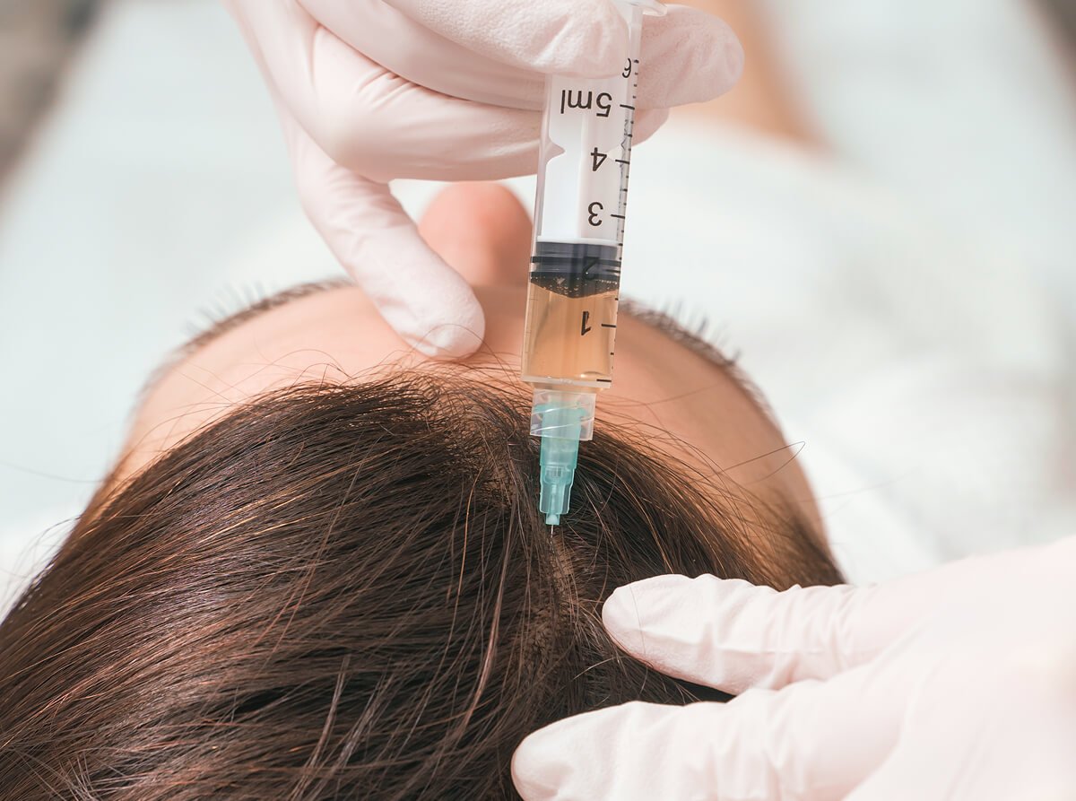 terapias-injetaveis-cabelo-tratamento-capilar-queda-alopecia