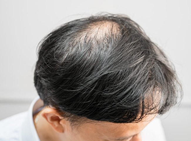 Queda de cabelo hormonal especialista medico tratamento